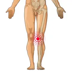 Anatomische Darstellung des menschlichen Beins mit Fokus auf das Knie. Ein roter Kreis mit konzentrischen Ringen um das Knie deutet auf Schmerzen hin, die auf verklebte Faszien im Knie hindeuten könnten.
