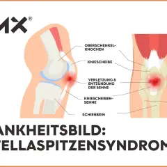 Anatomische Darstellung des Knies mit Hervorhebung der Patellaspitze, wo eine Verletzung und Entzündung der Sehne vorliegt. Das Patellaspitzensyndrom geht nicht weg.