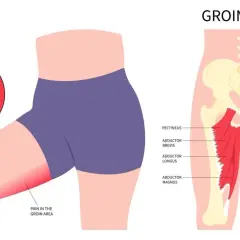 Illustration zeigt eine Leistenzerrung oder einen Bruch der Adduktorenmuskeln, mit Schmerz im Leistenbereich.