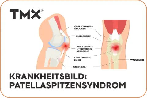 Anatomische Darstellung des Knies mit Hervorhebung der Patellaspitze, wo eine Verletzung und Entzündung der Sehne vorliegt. Das Patellaspitzensyndrom geht nicht weg.
