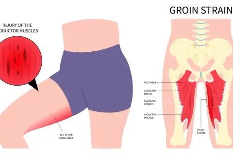 Illustration zeigt eine Leistenzerrung oder einen Bruch der Adduktorenmuskeln, mit Schmerz im Leistenbereich.
