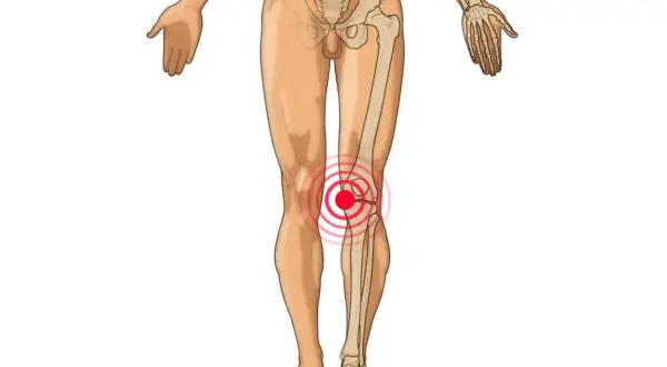 Anatomische Darstellung des menschlichen Beins mit Fokus auf das Knie. Ein roter Kreis mit konzentrischen Ringen um das Knie deutet auf Schmerzen hin, die auf verklebte Faszien im Knie hindeuten könnten.