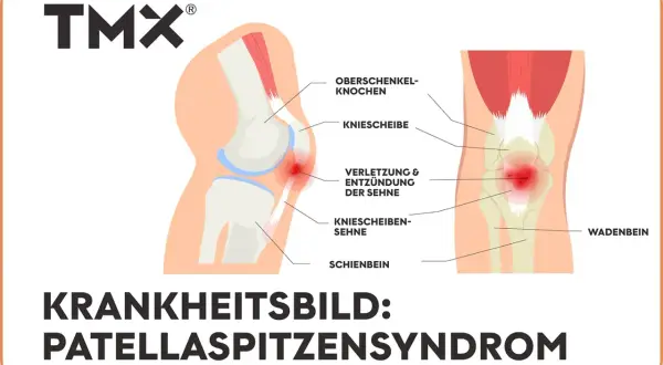 Anatomische Darstellung des Knies mit Hervorhebung der Patellaspitze, wo eine Verletzung und Entzündung der Sehne vorliegt. Das Patellaspitzensyndrom geht nicht weg.