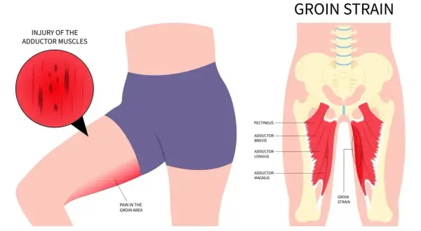 Illustration zeigt eine Leistenzerrung oder einen Bruch der Adduktorenmuskeln, mit Schmerz im Leistenbereich.