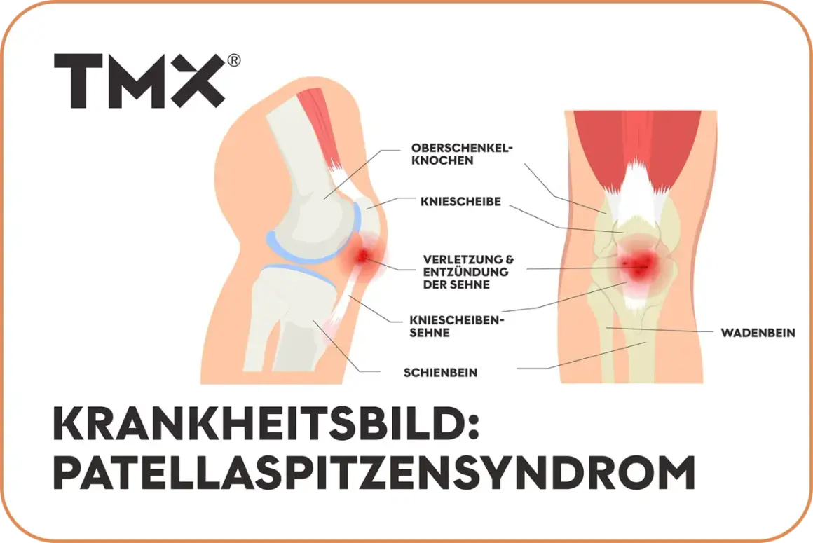 Anatomische Darstellung des Knies mit Hervorhebung der Patellaspitze, wo eine Verletzung und Entzündung der Sehne vorliegt. Das Patellaspitzensyndrom geht nicht weg.