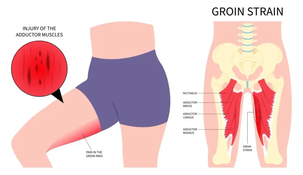 Illustration zeigt eine Leistenzerrung oder einen Bruch der Adduktorenmuskeln, mit Schmerz im Leistenbereich.