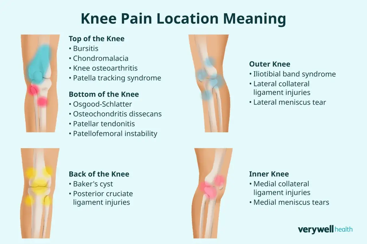 Schmerzpunkte am Knie: Oberseite, Unterseite, Außenseite, Innenseite und Rückseite. Beschreibt Ursachen für Schmerzen in der Kniekehle und anderen Bereichen.
