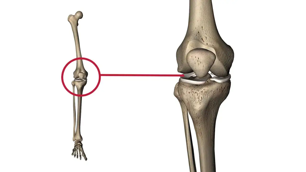 Kniegelenk-Anatomie mit Fokus auf Meniskus. M&ouml;gliche meniskusriss symptome test.