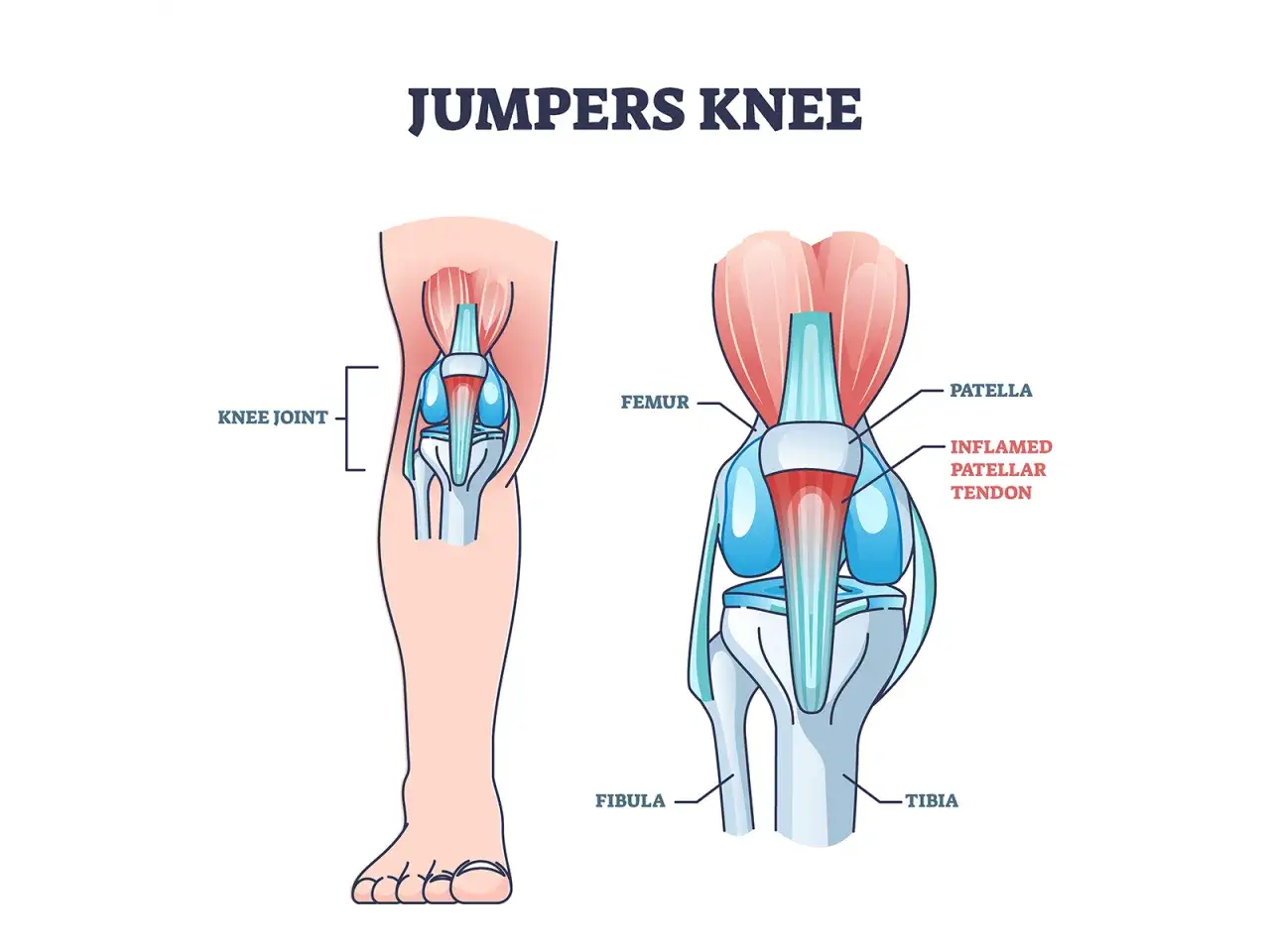 Illustration zeigt ein Kniegelenk mit entz&uuml;ndetem Patellasehnenband. Das Patellaspitzensyndrom geht nicht weg.