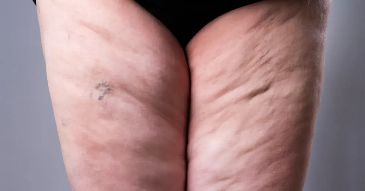 Nahaufnahme von Oberschenkeln mit sichtbaren Krampfadern und Cellulite, Anzeichen von schwachem Bindegewebe.