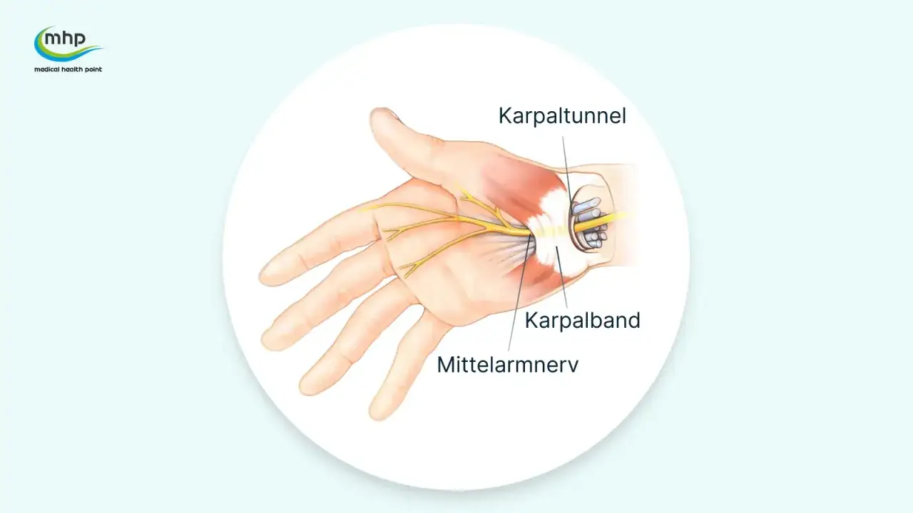 Anatomische Darstellung des Karpaltunnels, der den Mittelarmnerv und das Karpalband zeigt. Mögliche Ursache für Schmerzen im Handgelenk.