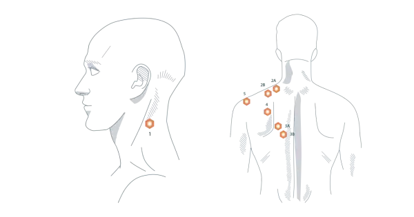 Illustration zeigt Punkte am Nacken und Rücken, die auf trapezmuskel schmerzen hinweisen.