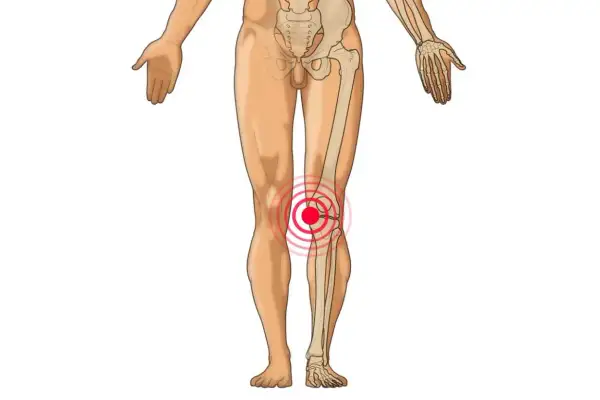 Anatomische Darstellung des menschlichen Beins mit Fokus auf das Knie. Ein roter Kreis mit konzentrischen Ringen um das Knie deutet auf Schmerzen hin, die auf verklebte Faszien im Knie hindeuten könnten.
